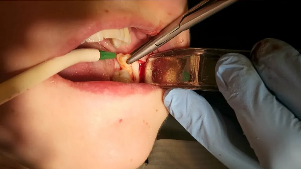 Dentist performing an emergency tooth extraction in a modern Tulsa dental office